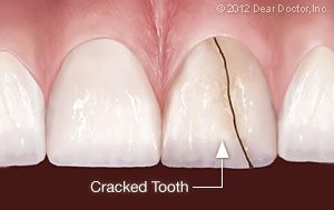 cracked-tooth